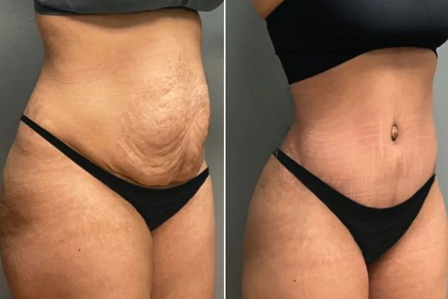 Liposuction