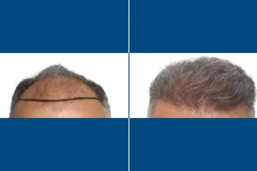 Long DHI Hair Transplantation: Fuller Hair, Naturally
