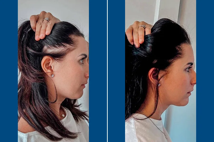 Low-Level Laser Therapy (LLLT)