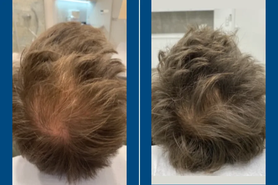 Low-Level Laser Therapy (LLLT)