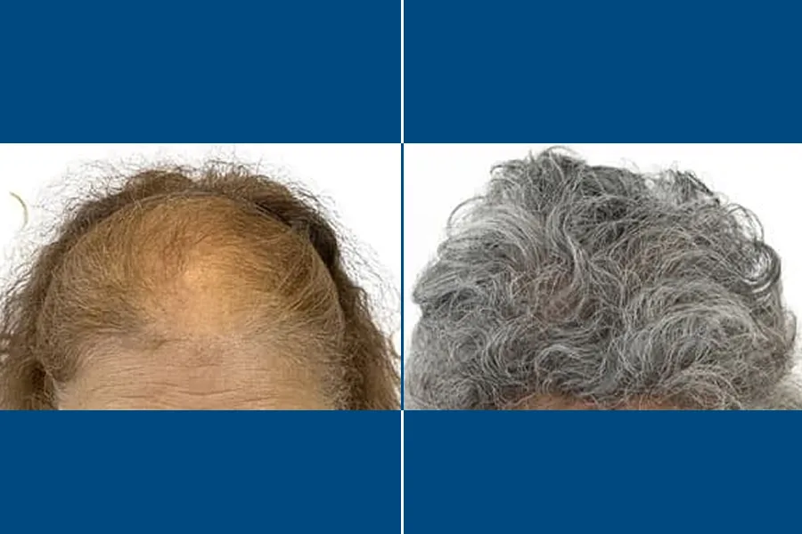 Low-Level Laser Therapy (LLLT)