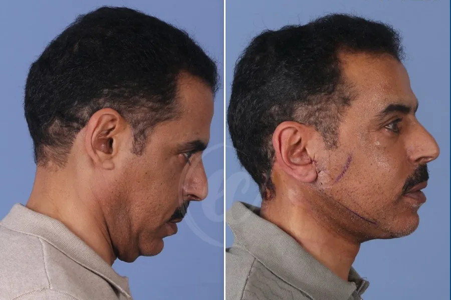 Neck Lift