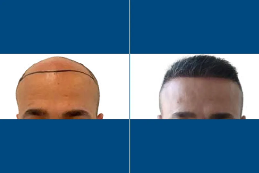 Needle-Free Hair Transplantation: Regrow Hair Comfortably