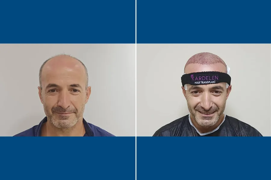 Needle-Free Hair Transplantation: Regrow Hair Comfortably