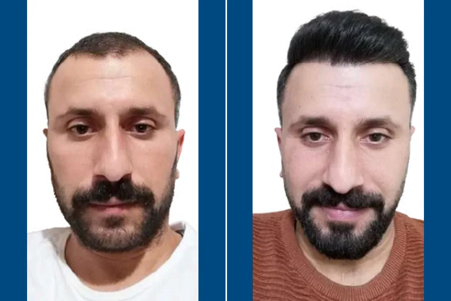 NEO FUE Hair Transplantation: Revive Your Hairline