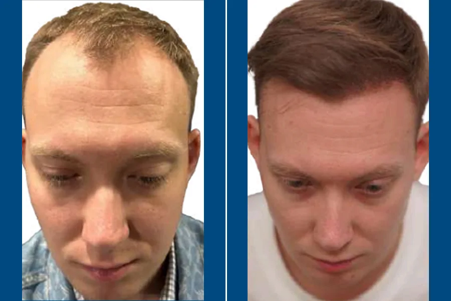 NEO FUE Hair Transplantation: Revive Your Hairline
