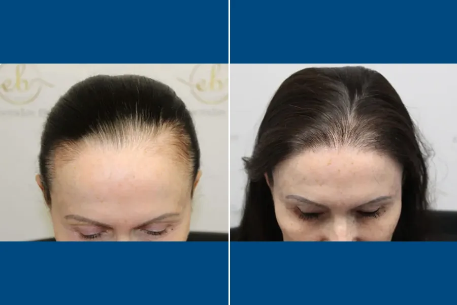 NEO FUE Hair Transplantation: Revive Your Hairline