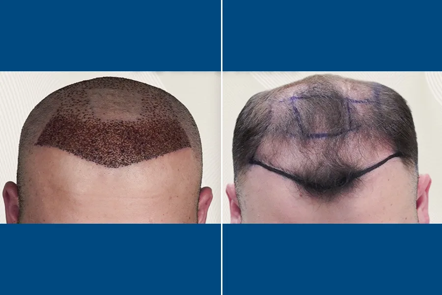 No-Shave Hair Transplantation: Regrow Hair Seamlessly