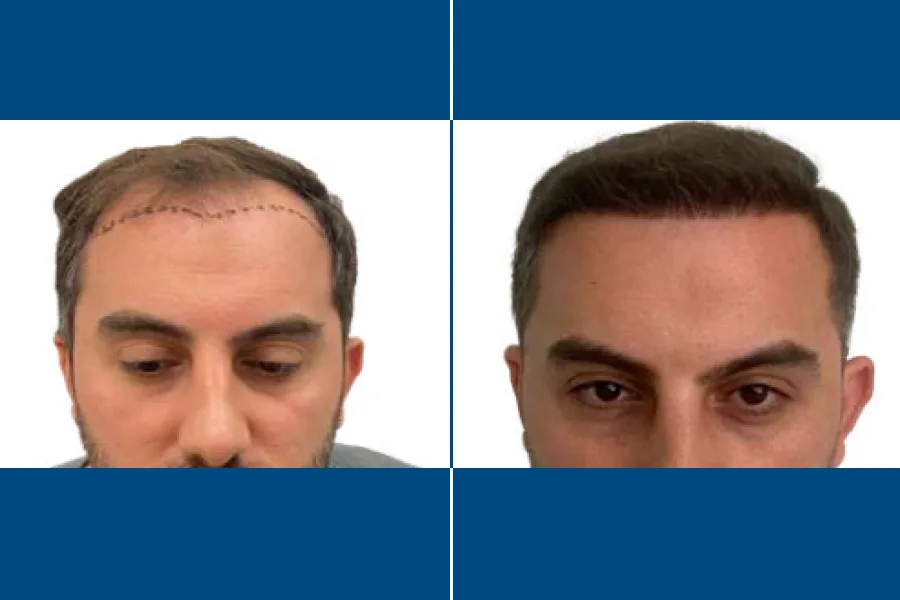Percutaneous Hair Transplantation: Revive Your Roots