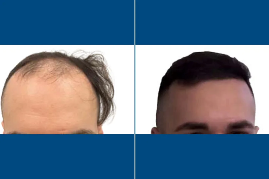 Percutaneous Hair Transplantation: Revive Your Roots