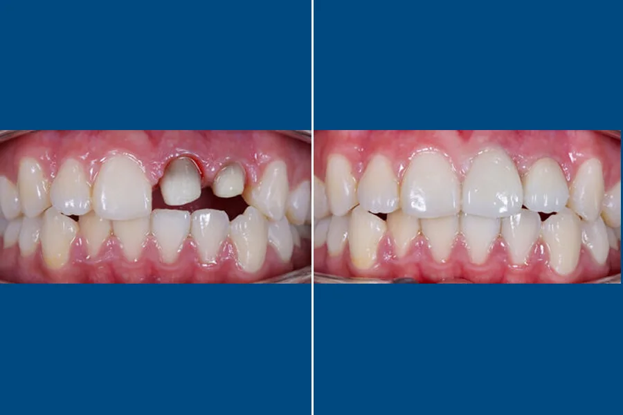 PFM Crown (Porcelain-Fused-to-Metal)