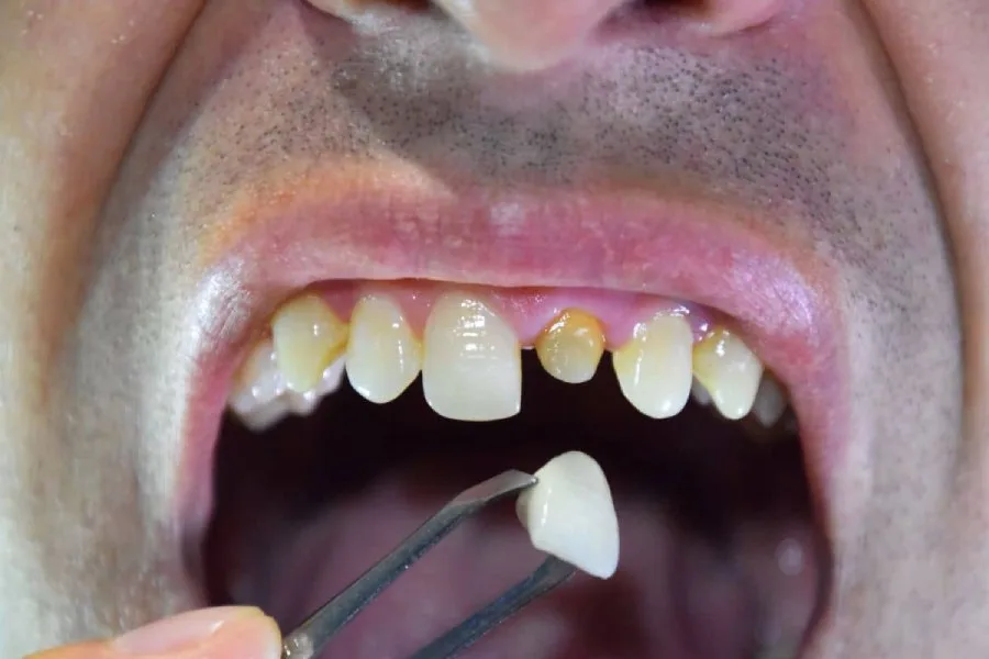 PFM Crown (Porcelain-Fused-to-Metal)