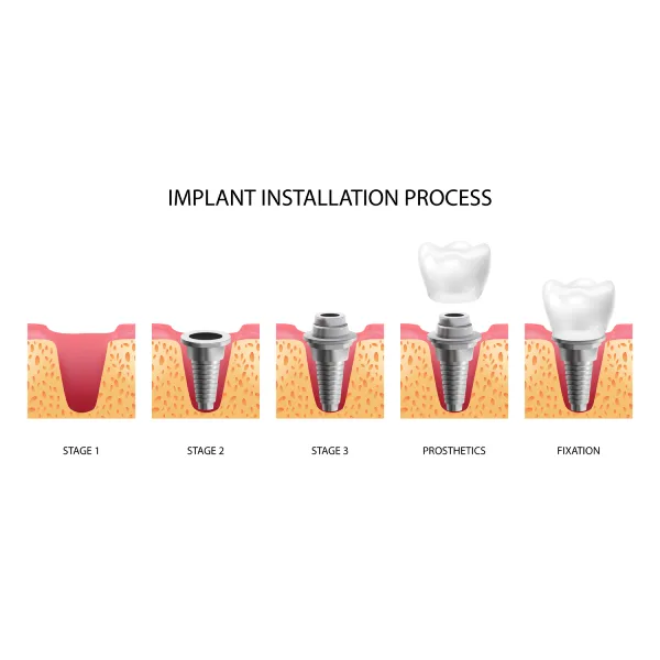 PFM Crown (Porcelain-Fused-to-Metal)