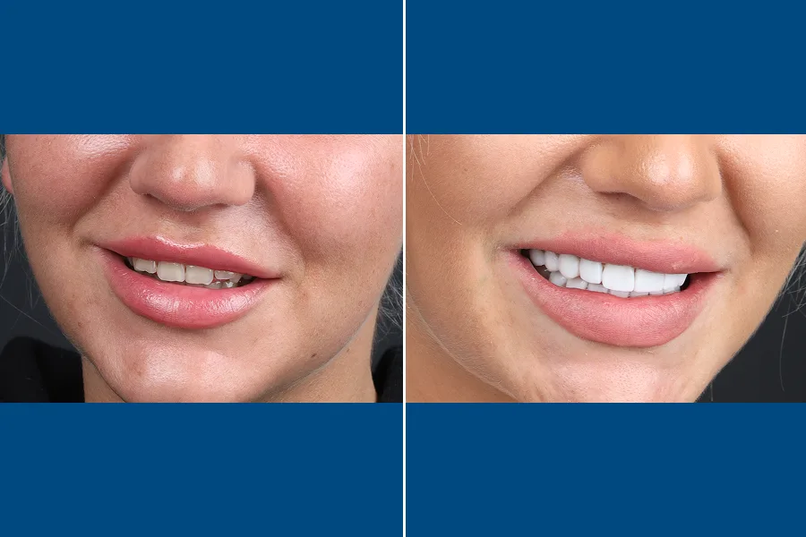 Porcelain Laminate Veneer