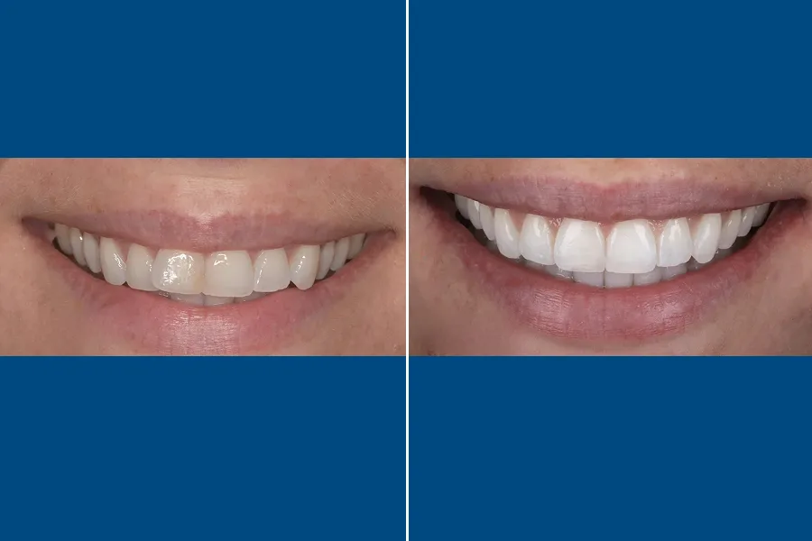 Professional Teeth Whitening