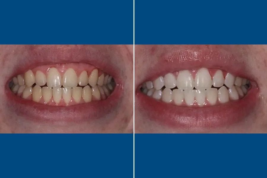 Professional Teeth Whitening