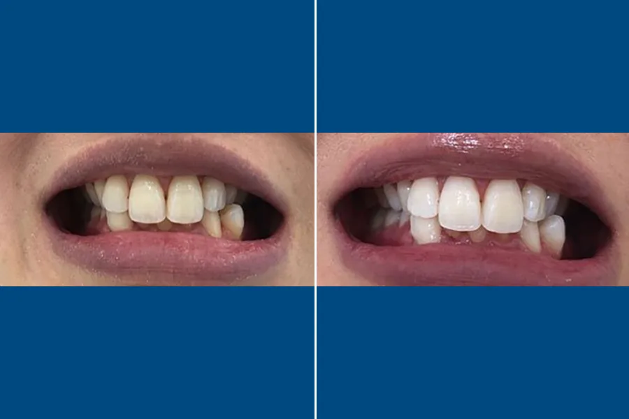 Professional Teeth Whitening