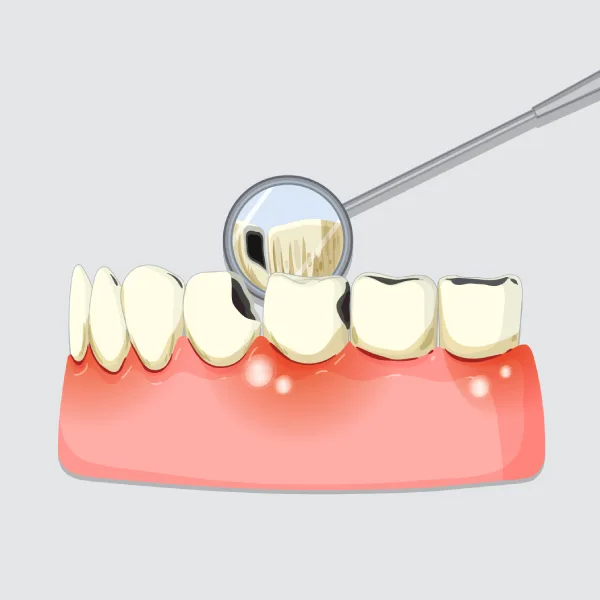 Professional Teeth Whitening