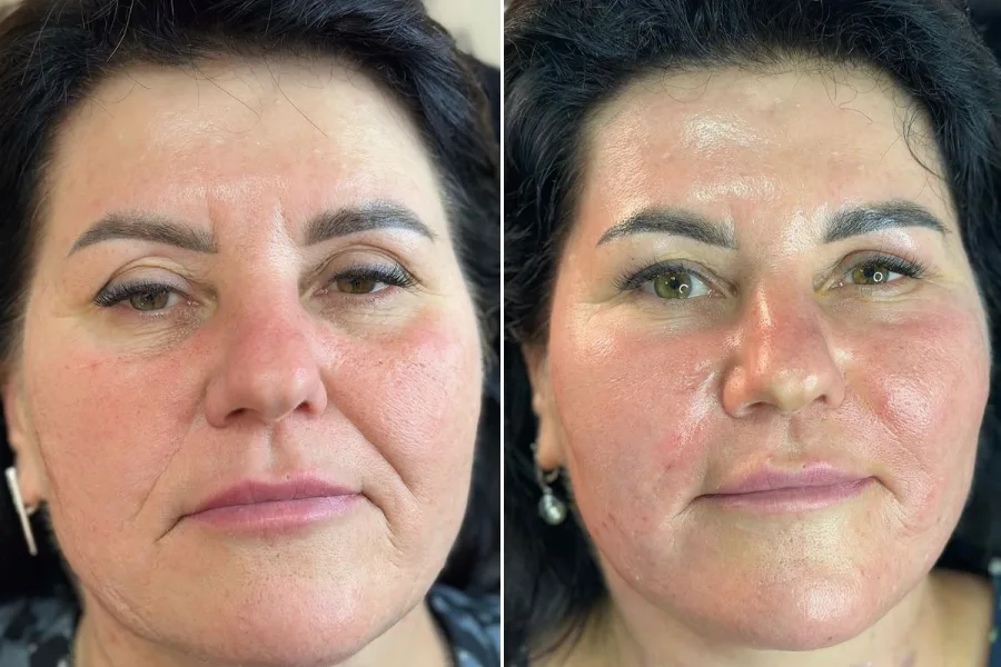 PRP Facial Rejuvenation