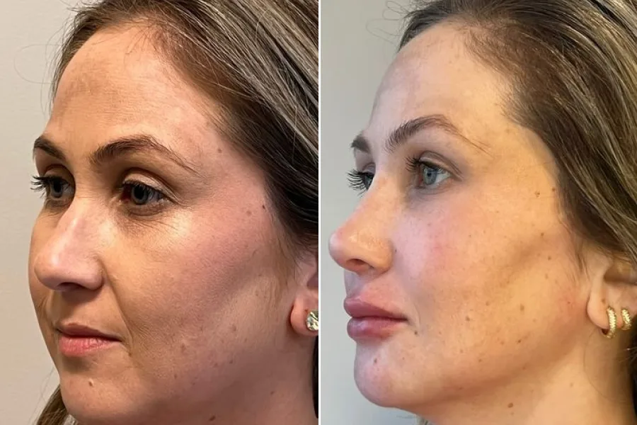 PRP Facial Rejuvenation