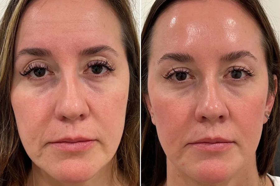 PRP Facial Rejuvenation