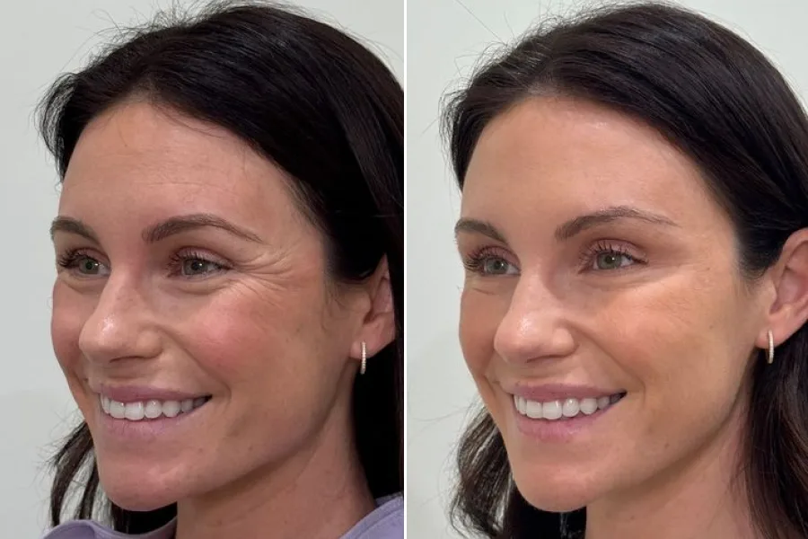 PRP Facial Rejuvenation