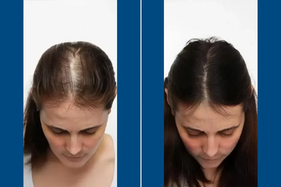 PRP Hair Therapy: Revitalize Your Roots