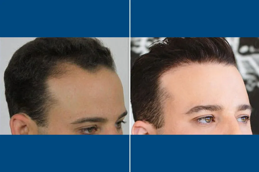 PRP Hair Therapy: Revitalize Your Roots