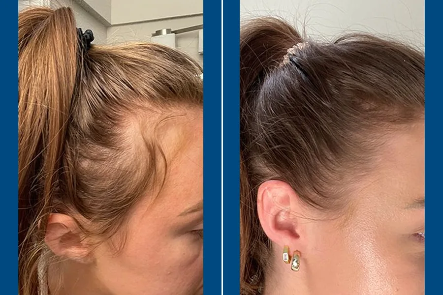 PRP Hair Therapy: Revitalize Your Roots