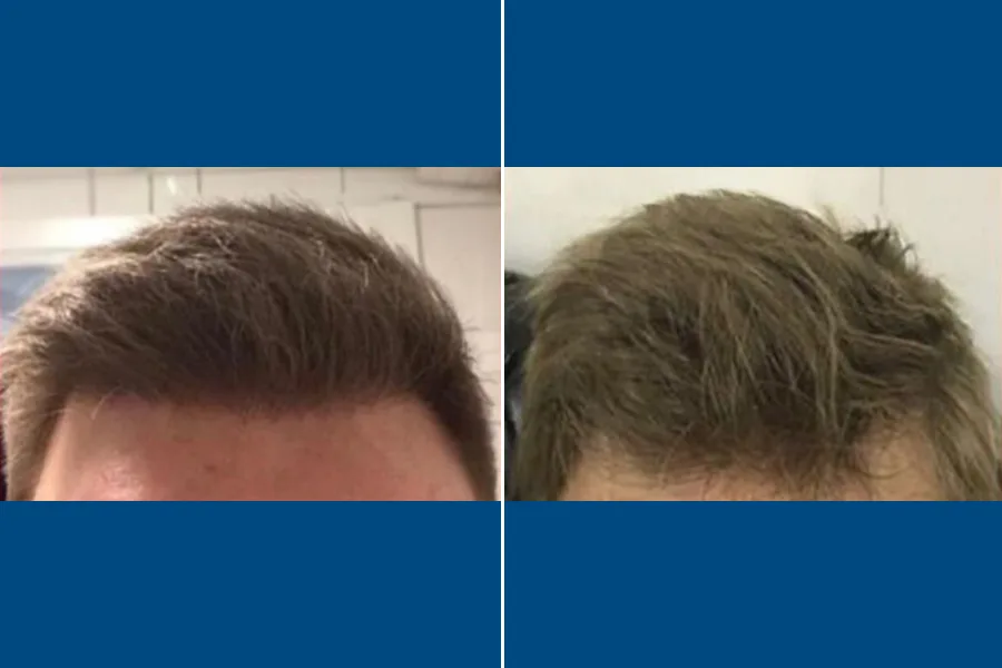 Revision Hair Transplantation: Restore Your Roots