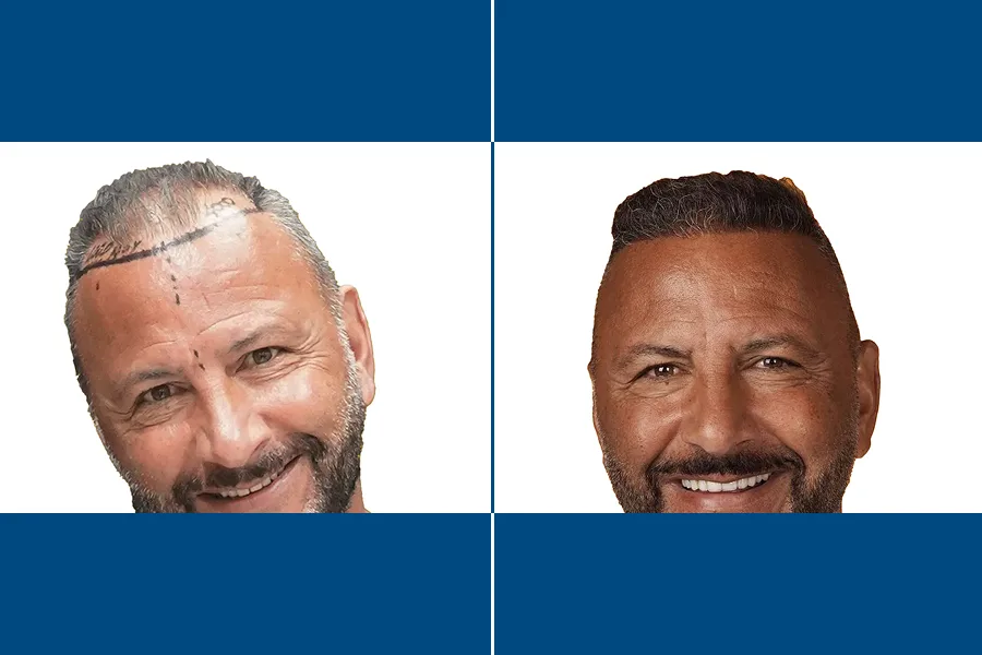 Revision Hair Transplantation: Restore Your Roots