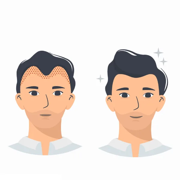 Revision Hair Transplantation