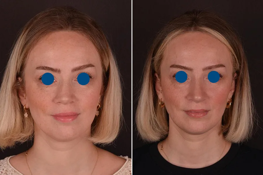 Revision Rhinoplasty