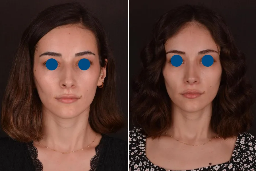 Revision Rhinoplasty