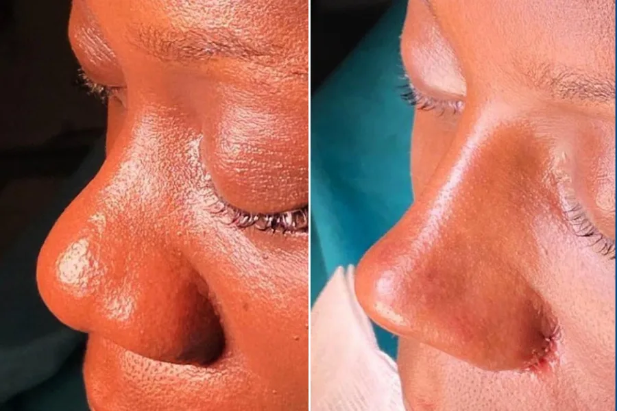 Revision Rhinoplasty