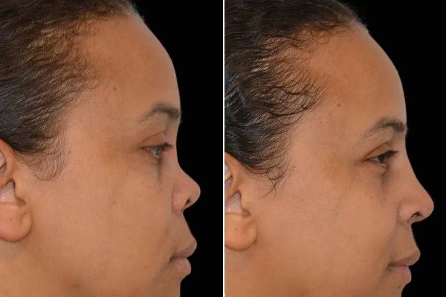 Revision Rhinoplasty
