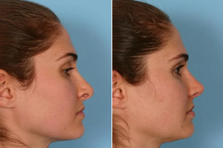 Revision Rhinoplasty