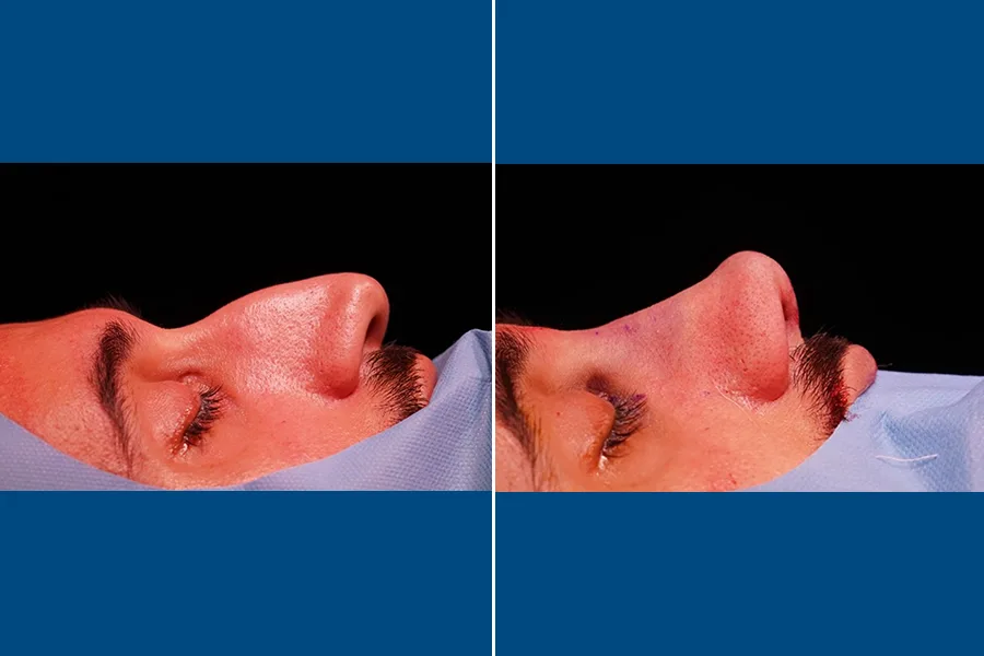 Rhinoplasty