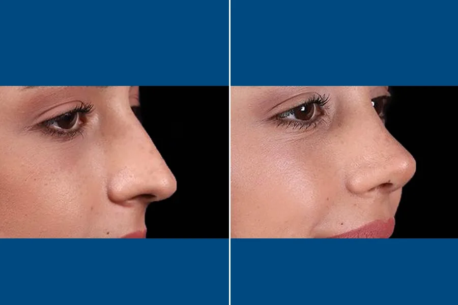 Rhinoplasty