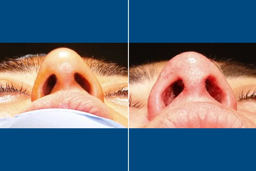 Rhinoplasty