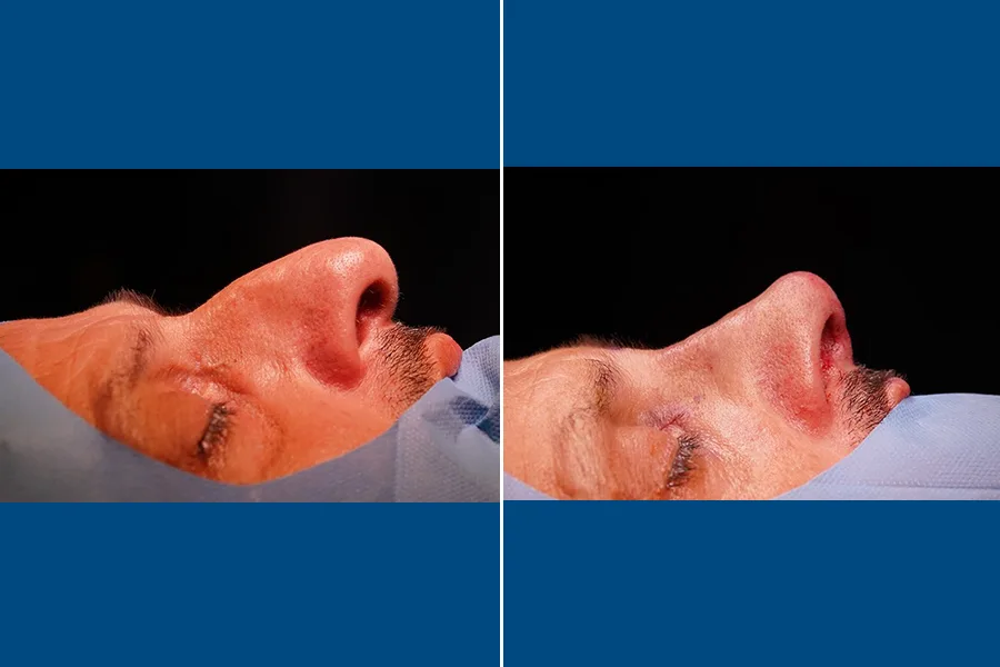 Rhinoplasty