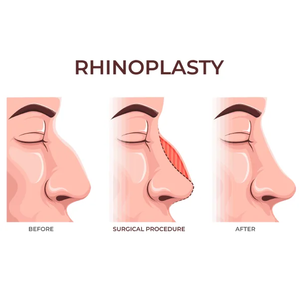 Rhinoplasty