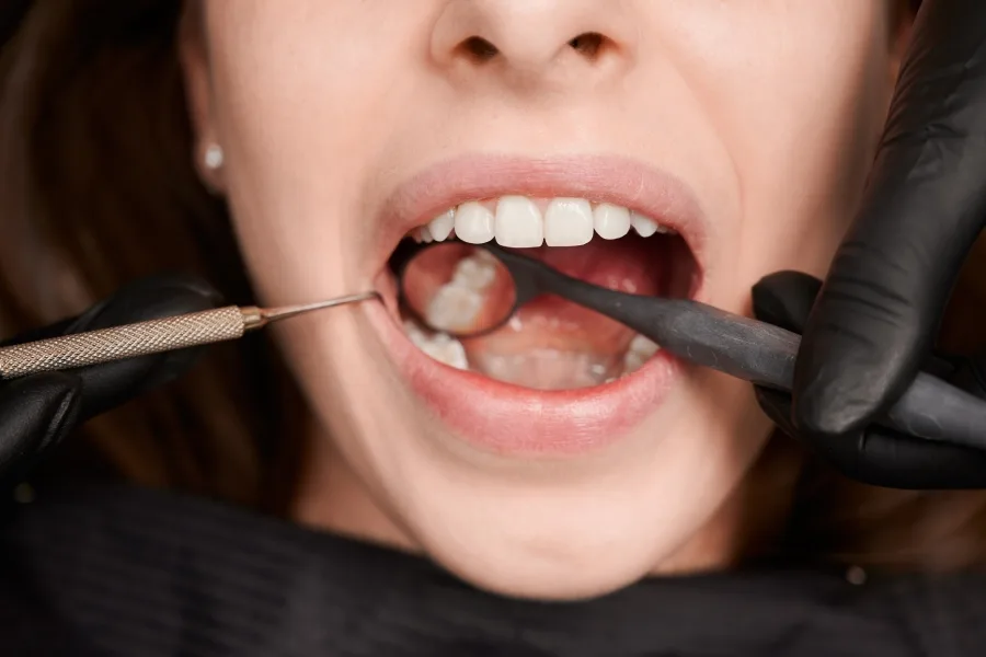 Root Canal Treatment