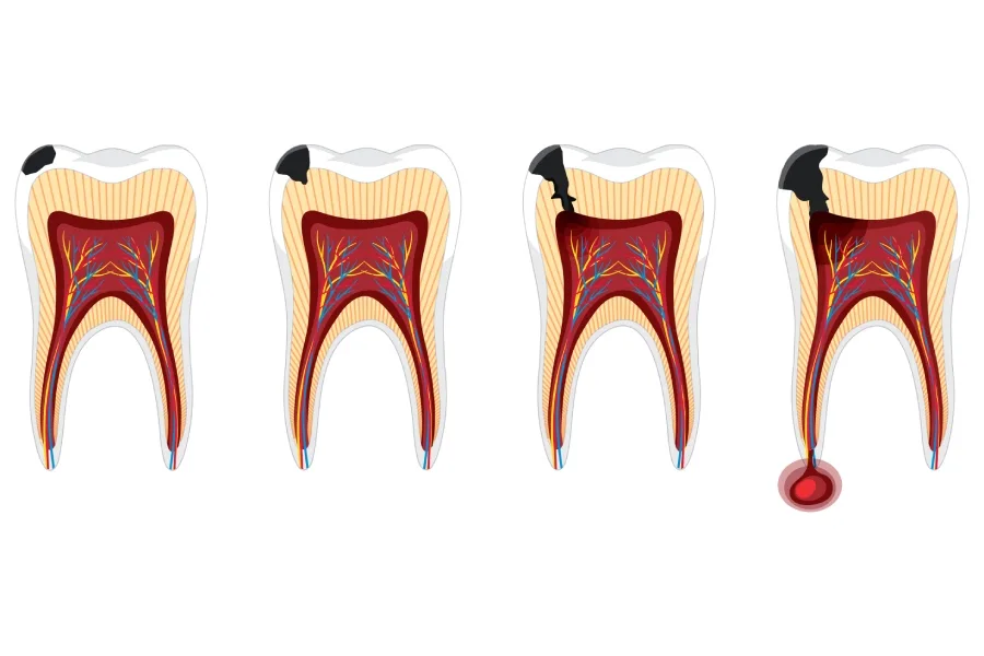 Root Canal Treatment