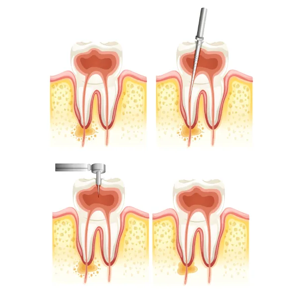 Root Canal Treatment