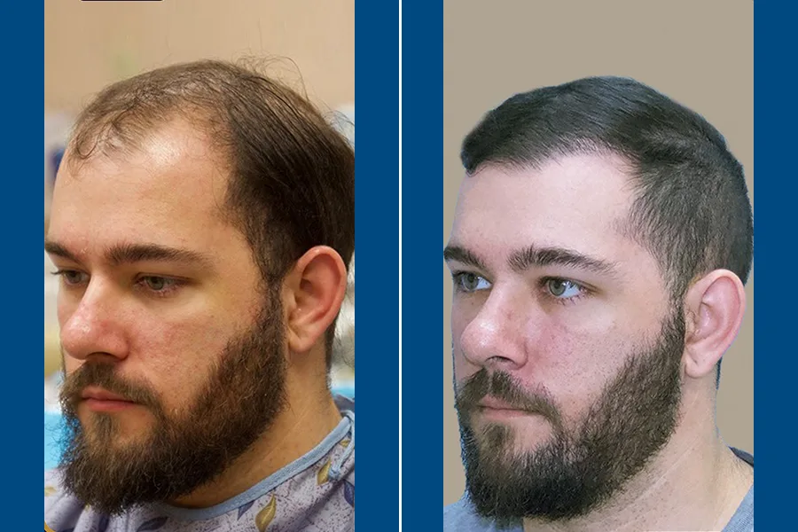Sapphire FUE Hair Transplantation: Shine with New Hair