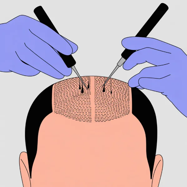 SDHI Hair Transplantation