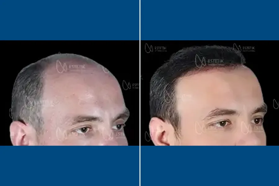 Shaven Hair Transplantation: Renew Your Roots