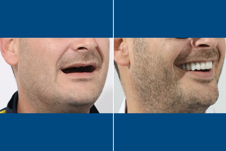 Single Dental Implant