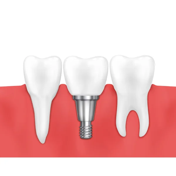 Single Dental Implant